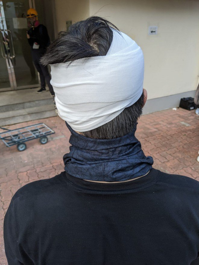 A protester at Chinese University says he was hit on the forehead by an unknown projectile during a clash. Another protester was seen on fire from a petrol bomb earlier